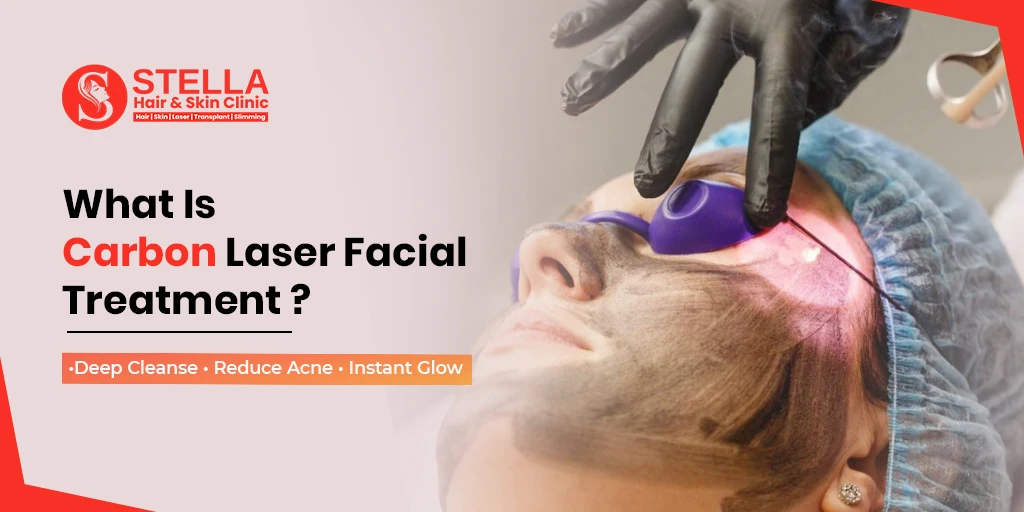 Beyond Ordinary Glow With Carbon Laser Facial Treatment
